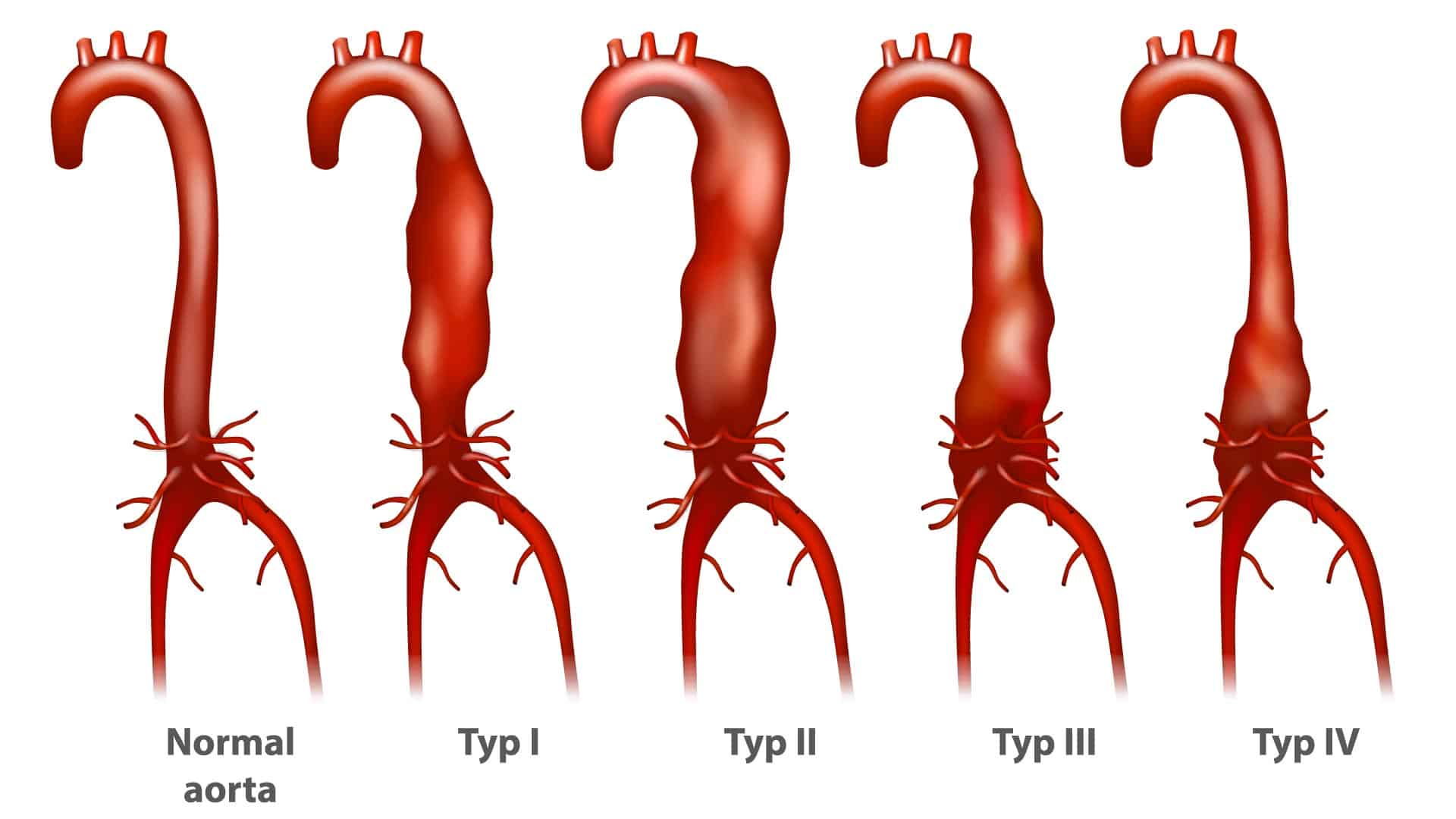 diagram of aortas affected by Abdominal Aortic Disease - Maryland Vascular Specialists